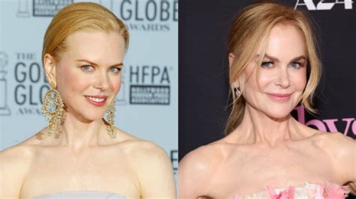 Nicole Kidman Facelift | Plastic Surgery Before And After ·